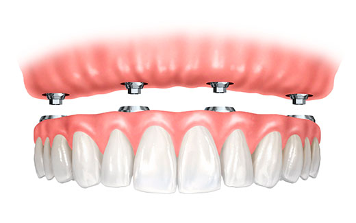 implant supported denture mississauga on dentist