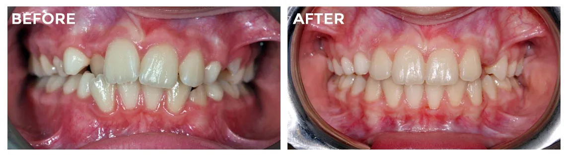 invisalign-dentist-in-mississauga-before-after-photo-1