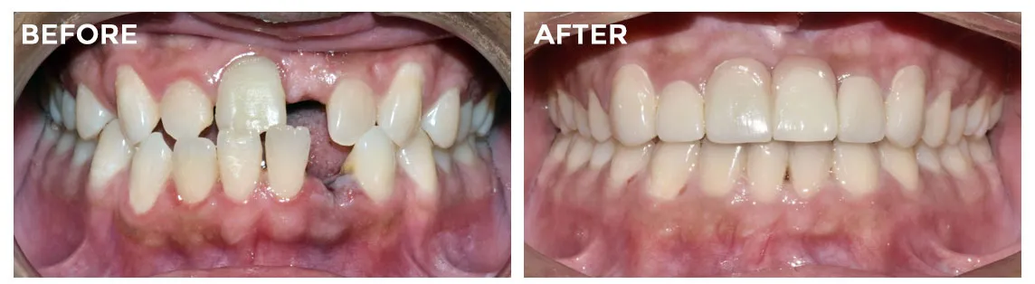 invisalign-dentist-in-mississauga-before-after-photo-2